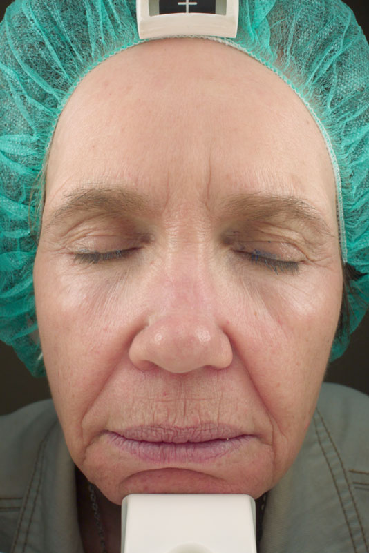 A woman's face after receiving Vivace RF microneedling treatment