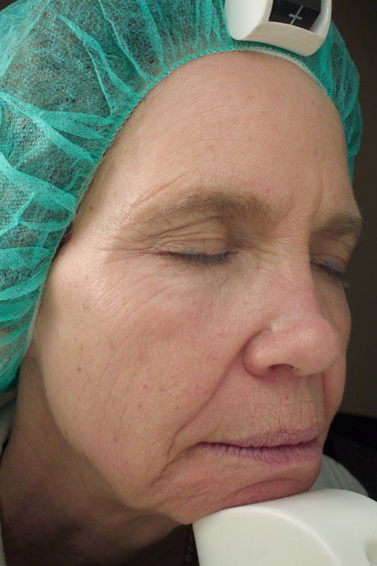 A woman's face before receiving Vivace RF microneedling treatment