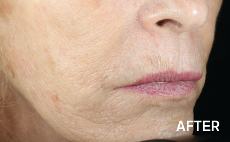Close up of a woman's mouth and chin after Vivace RF microneedling