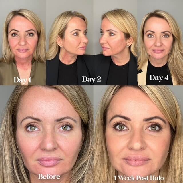 Several day time span of a face after a HALO treatment