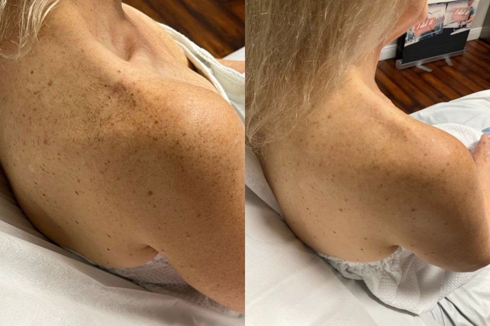 Before and after of reduction of freckles on a shoulder