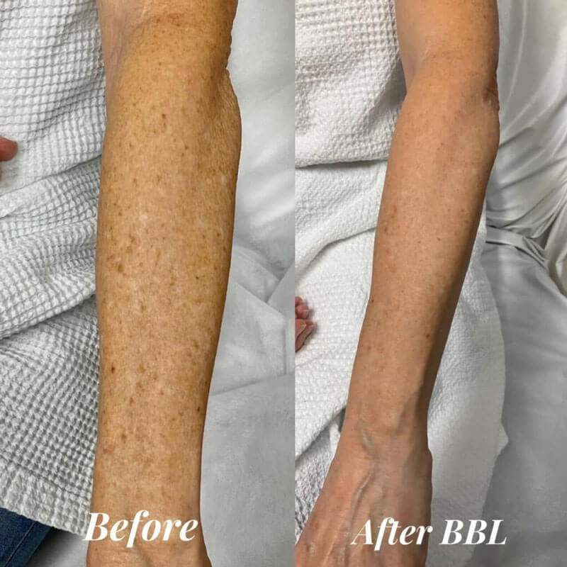 Before and after of reduction of freckles on an arm