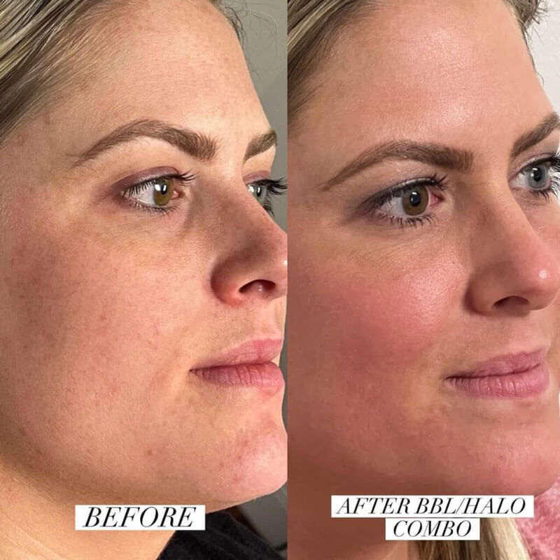 Before and after of a woman's face after a BBL/HALO combo treatment