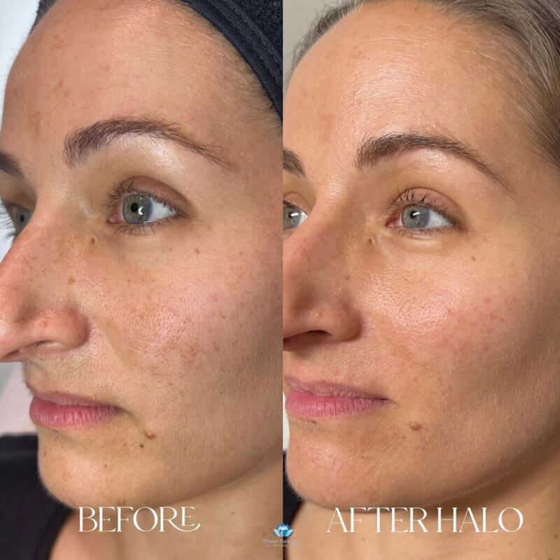 Before and after photo of woman's face after a HALO treatment