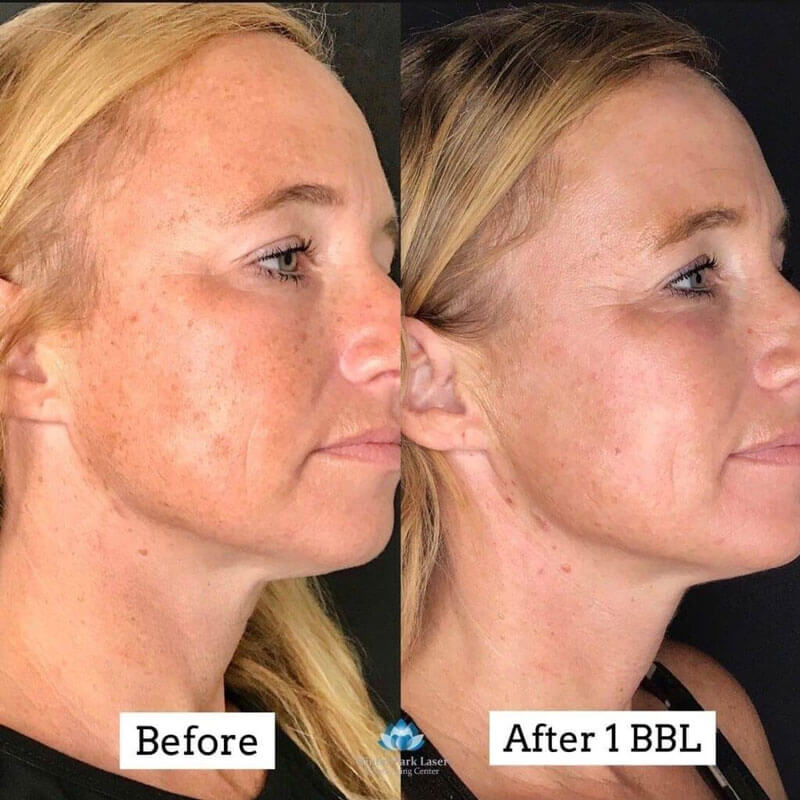 Before and after of reduction of freckles on a face