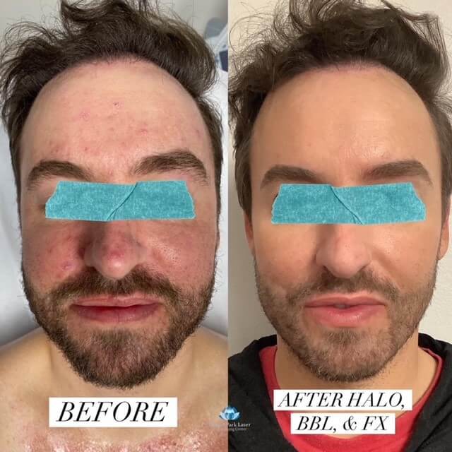 Before and after of redness reduction on a man's face