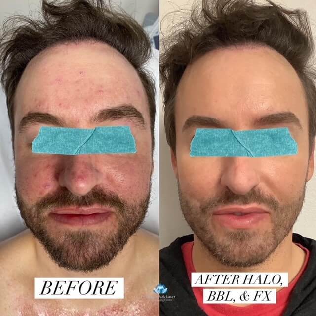 Before and after of man's face after HALO/BBL & FX treatment