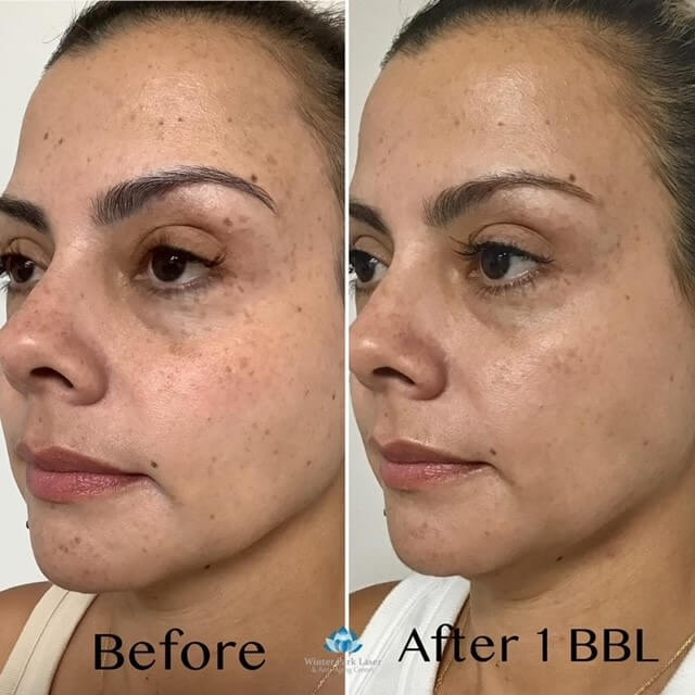 Before and after of a face after one BBL treatment