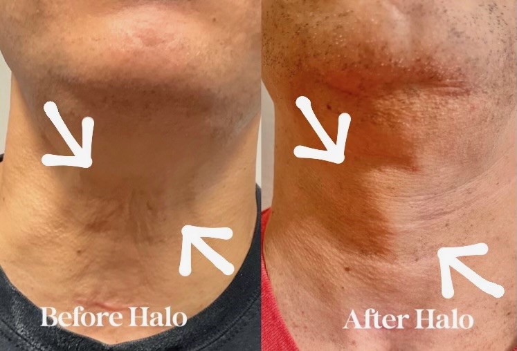 Before and after of a neck after a HALO treatment