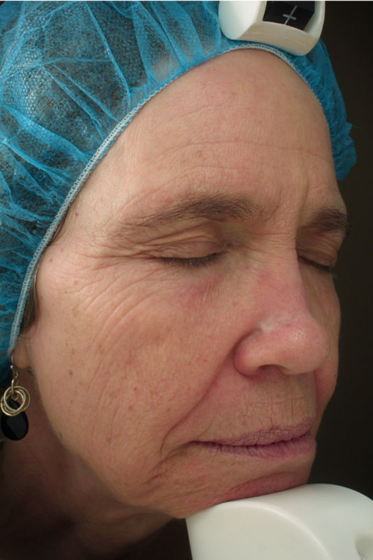 A woman's face before receiving Vivace RF microneedling treatment