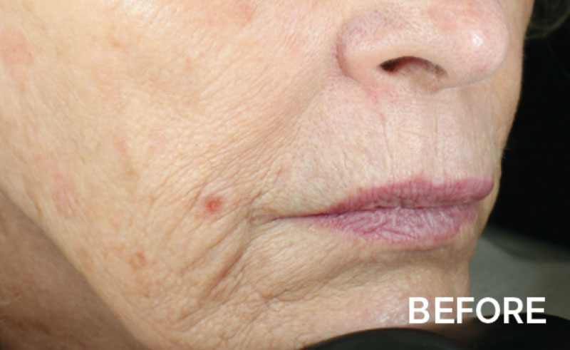 Close up of a woman's mouth and chin before Vivace RF microneedling