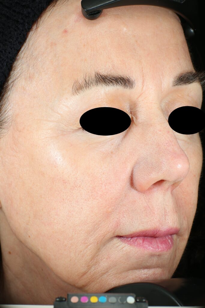A woman's face after receiving Vivace RF microneedling treatment