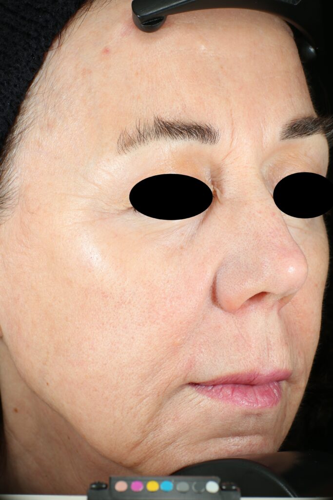 A woman's face after receiving Vivace RF microneedling treatment at Winter Park Laser & Anti-Aging Center