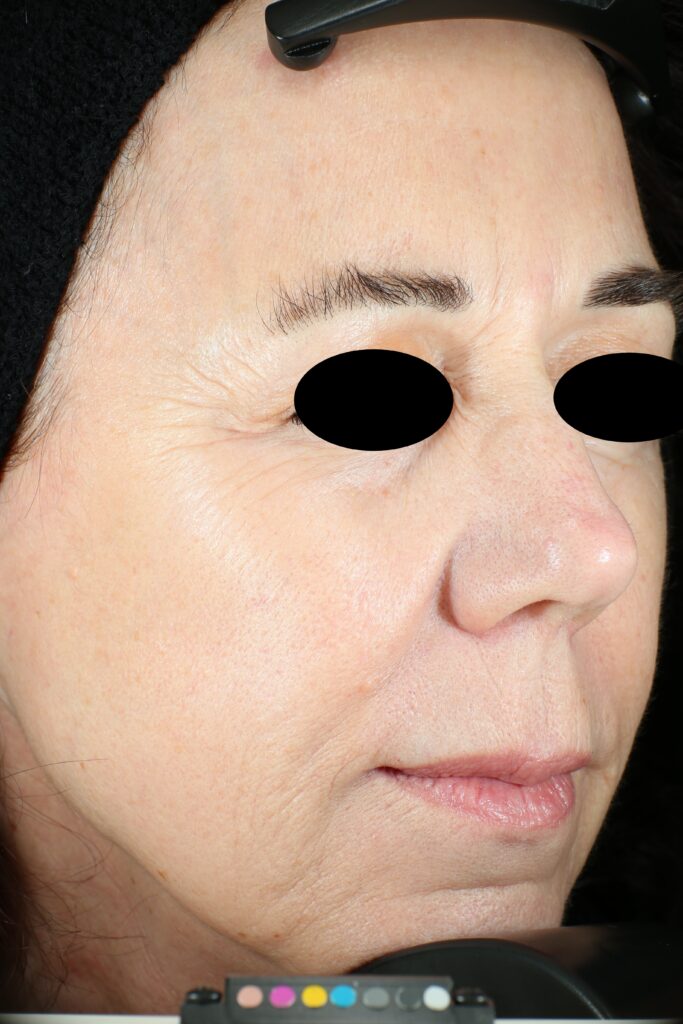 A woman's face before receiving Vivace RF microneedling treatment