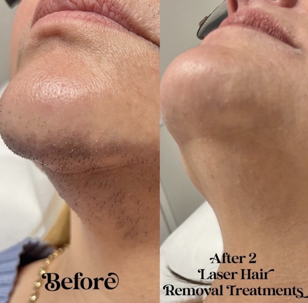 Before and after laser hair removal treatments on a woman's chin and neck