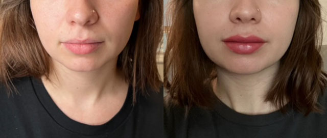 Before and after lip blush treatment on woman's lips