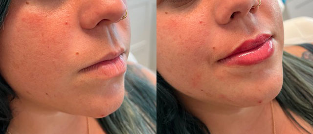 Before and after lip blush treatment on woman's lips