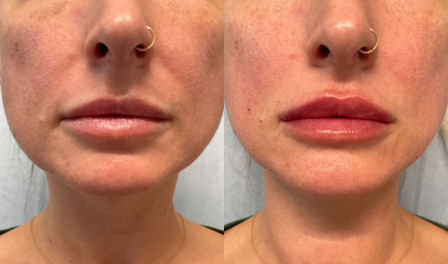 Before and after lip filler on woman's lips