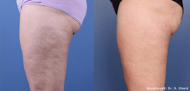 Before and after Morpheus8 treatment on thigh cellulite