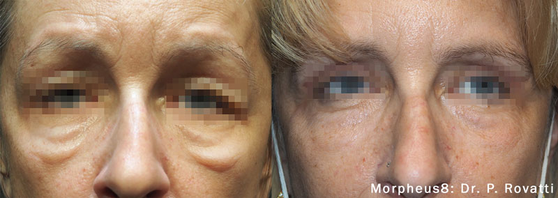 Before and after Morpheus8 treatment on under eye bags