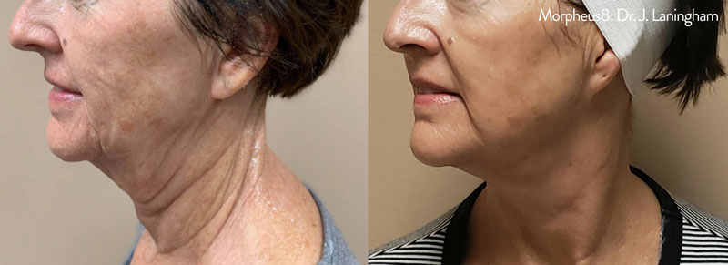 Before and after Morpheus8 treatment on chin and neck