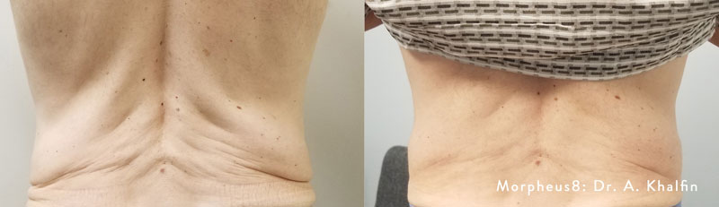 Before and after Morpheus8 treatment on a back