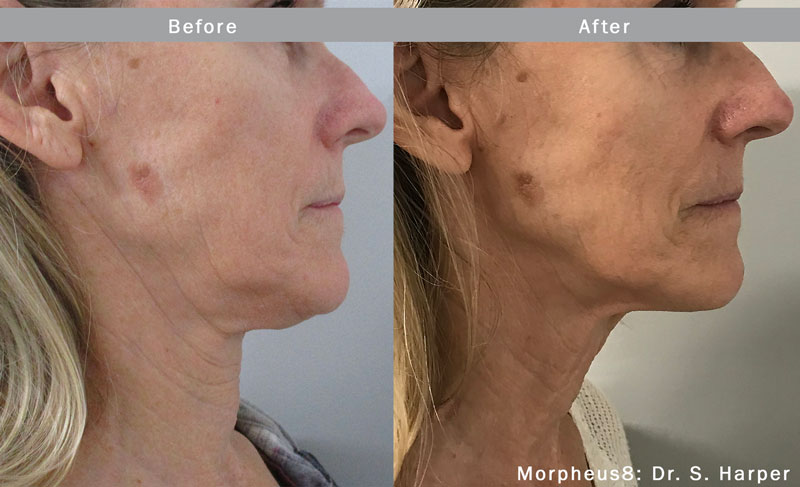 Before and after Morpheus8 treatment on chin and neck