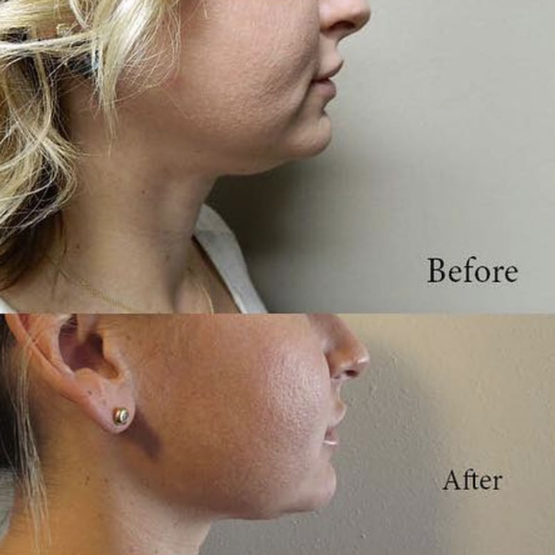 Before and after photos of a woman's side profile with KYBELLA® facial conturing