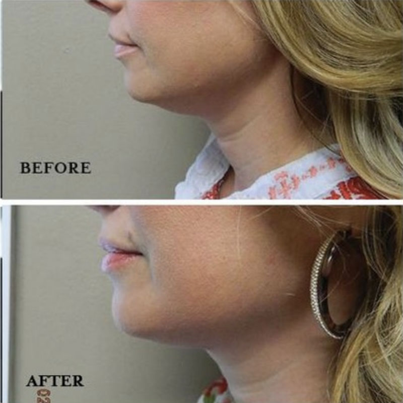 Before and after photos of a woman's chin with KYBELLA® facial conturing