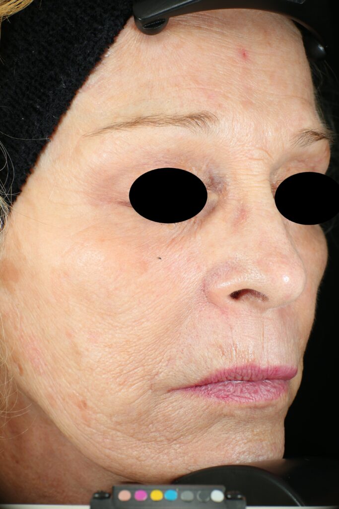 A woman's face after receiving Vivace RF microneedling treatment