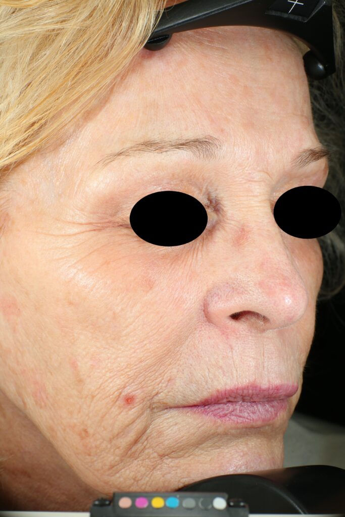 A woman's face before receiving Vivace RF microneedling treatment