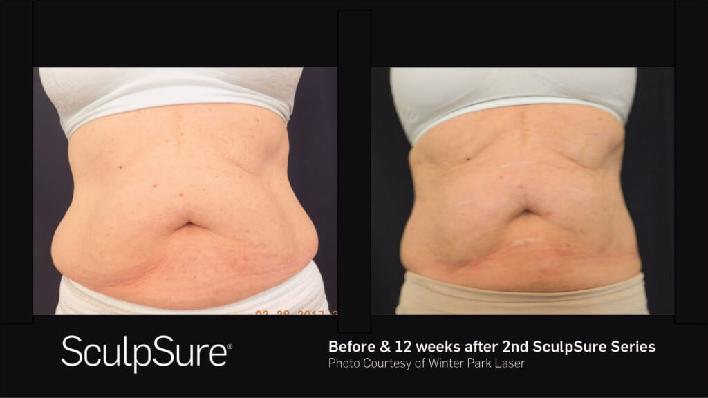 A woman's stomach before and twelve weeks after second SculpSure series