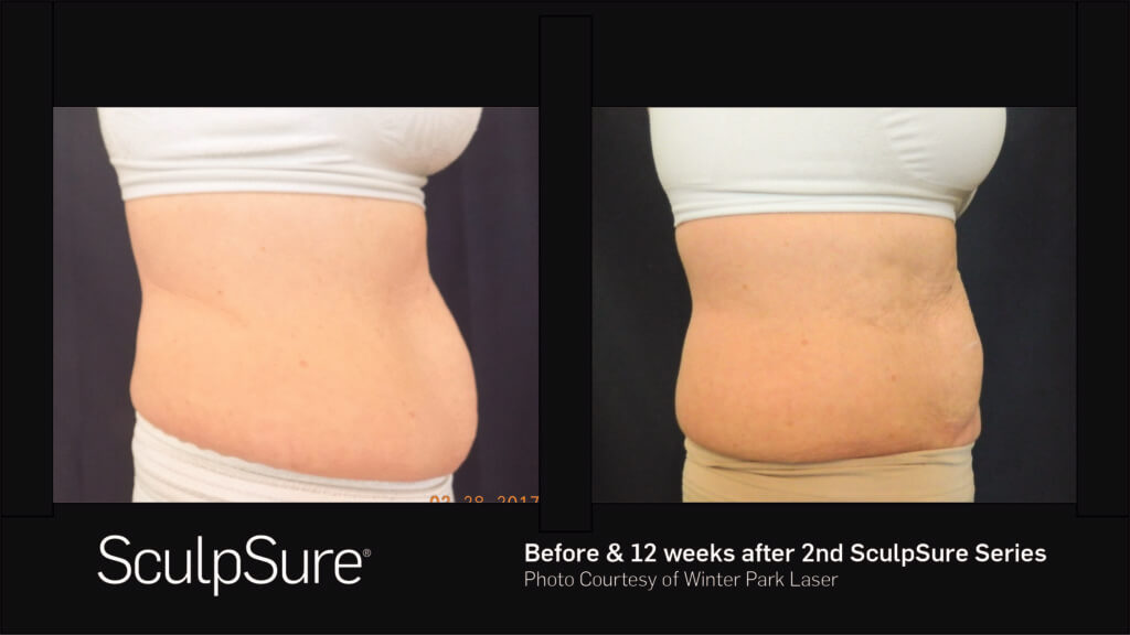 A woman's side before and twelve weeks after second SculpSure series