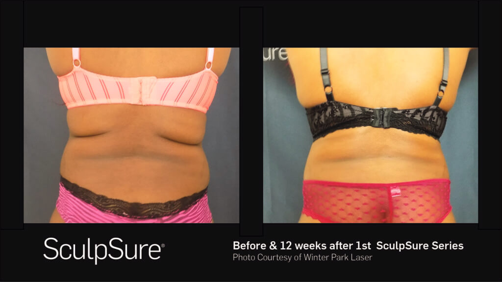 A woman's back before and twelve weeks after first SculpSure series