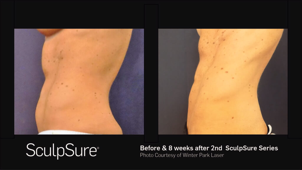 A man's torso before and 8 weeks after second SculpSure series