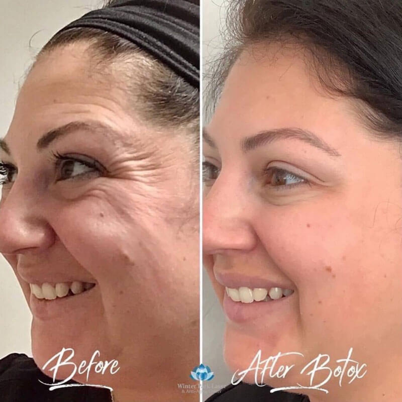 Woman's face before and after botox injections