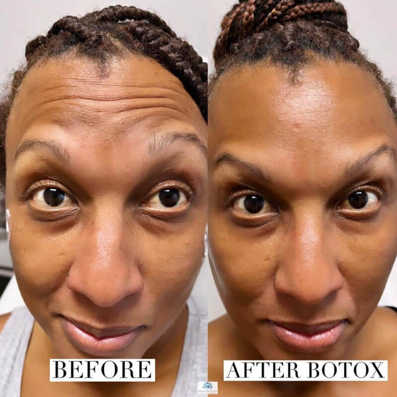 Forehead wrinkles before and after Botox injections