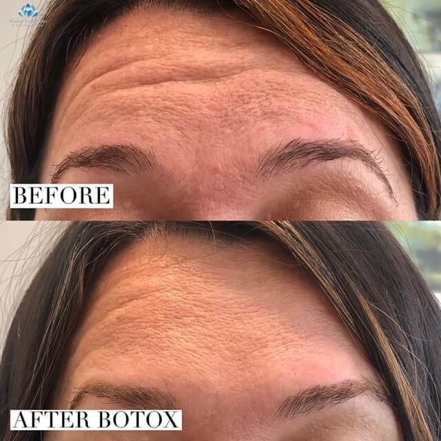 Woman's forehead wrinkles before and after Botox injections