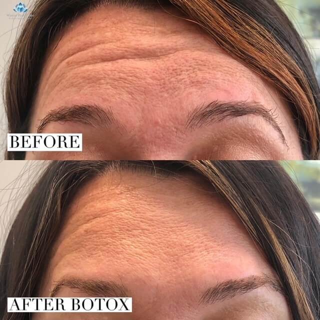 Forehead wrinkles before and after Botox injections