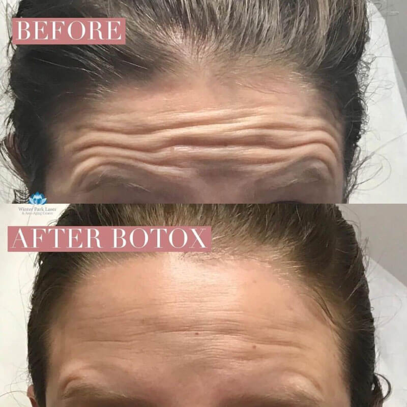 Forehead wrinkles before and after Botox injections