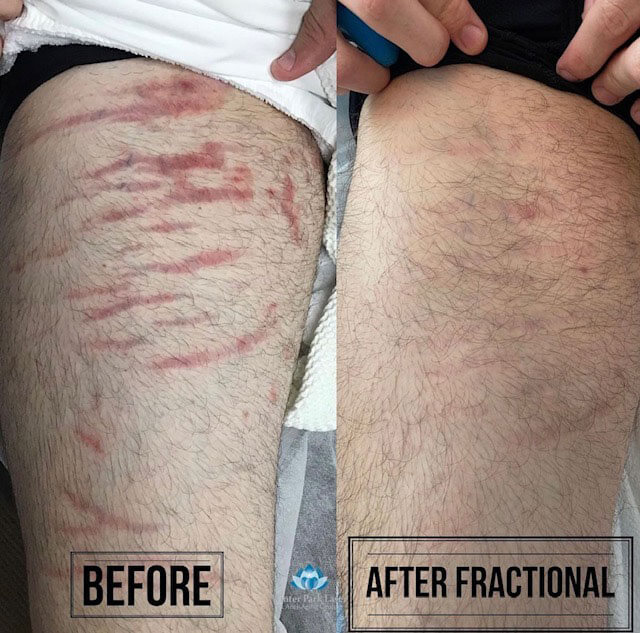Before and after images of a man's leg scarring after IPL treatment