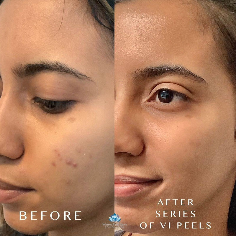 Before and after of acne after a series of VI Peels