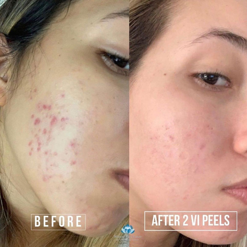 before and after clearing of facial acne after two VI peels