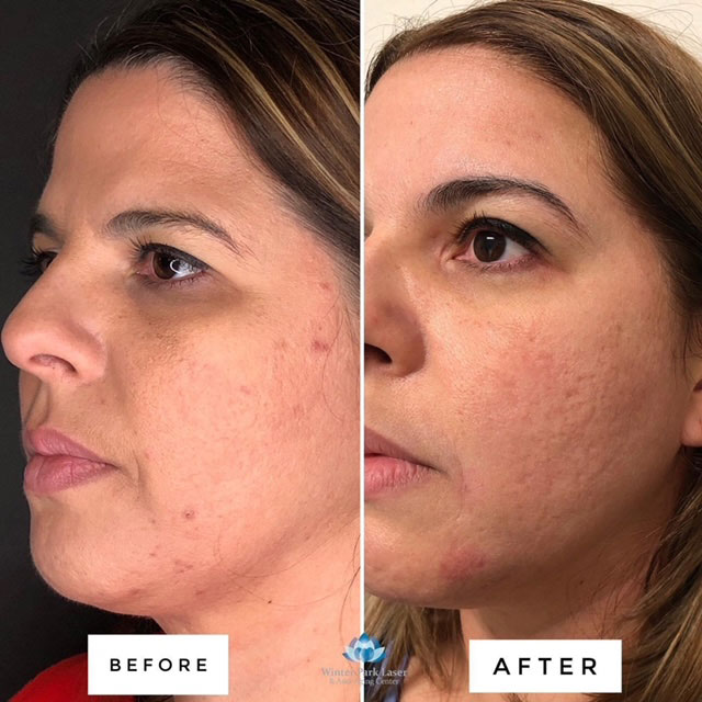 Before and After View of Acne Treatment of Woman's Face in Winter Park, FL