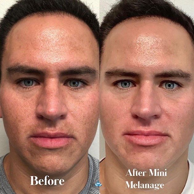 Before and after of a man's face after a mini melanage treatment