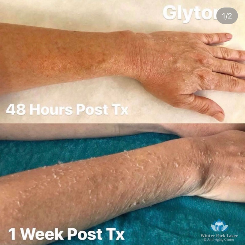 before and after of an arm during healing of glytone treatment