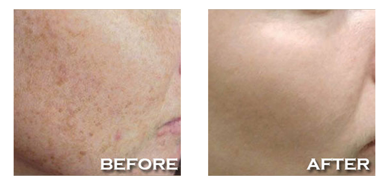 Before and after images of a person's cheek after IPL treatment