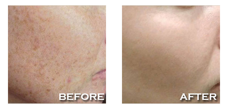 A Side View of Face Showcasing IPL Laser Treatment by Winter Park Laser Center