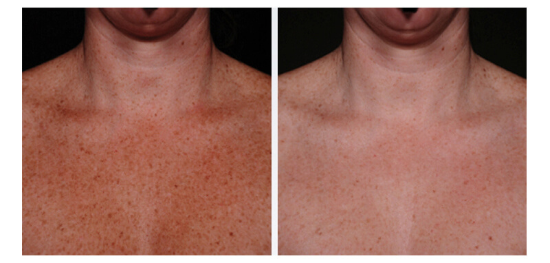 Before and after images of a person's chest after IPL treatment