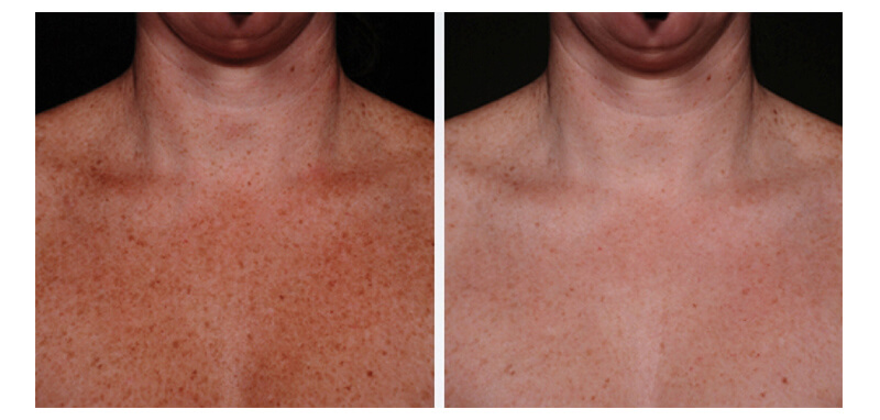 A Man's Chest View Highlighting After View of IPL Laser Treatment in Winter Park, FL